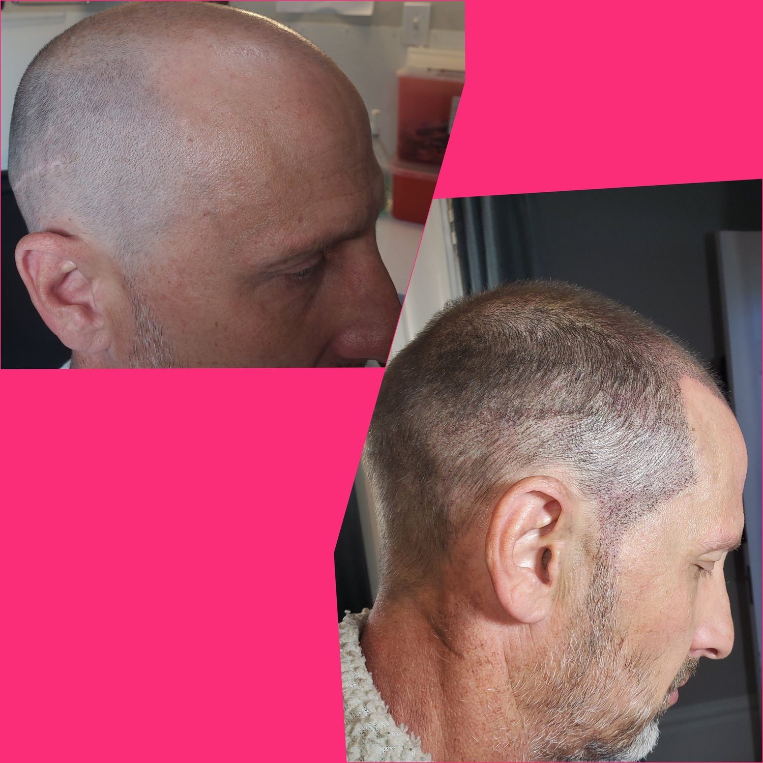 SMP / Scalp Micro-Pigmentation
