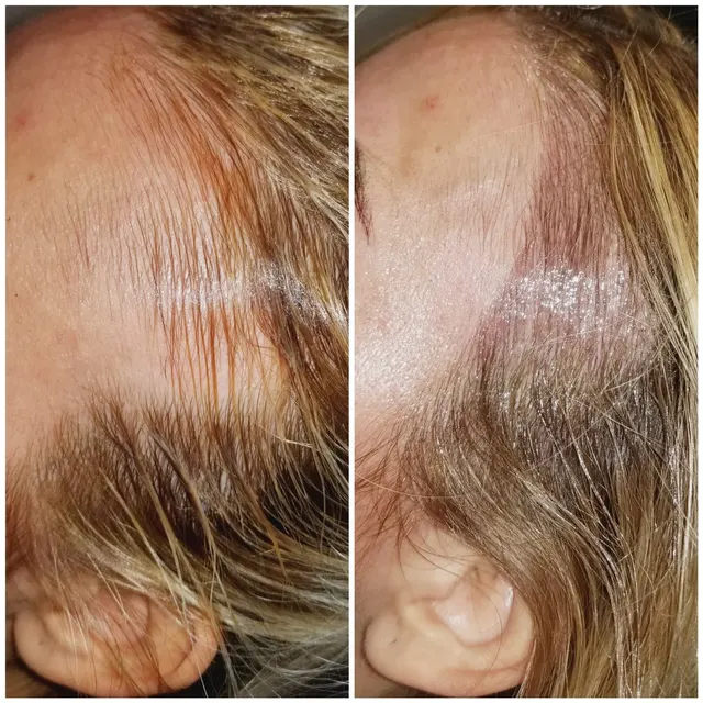 Scalp Microblading