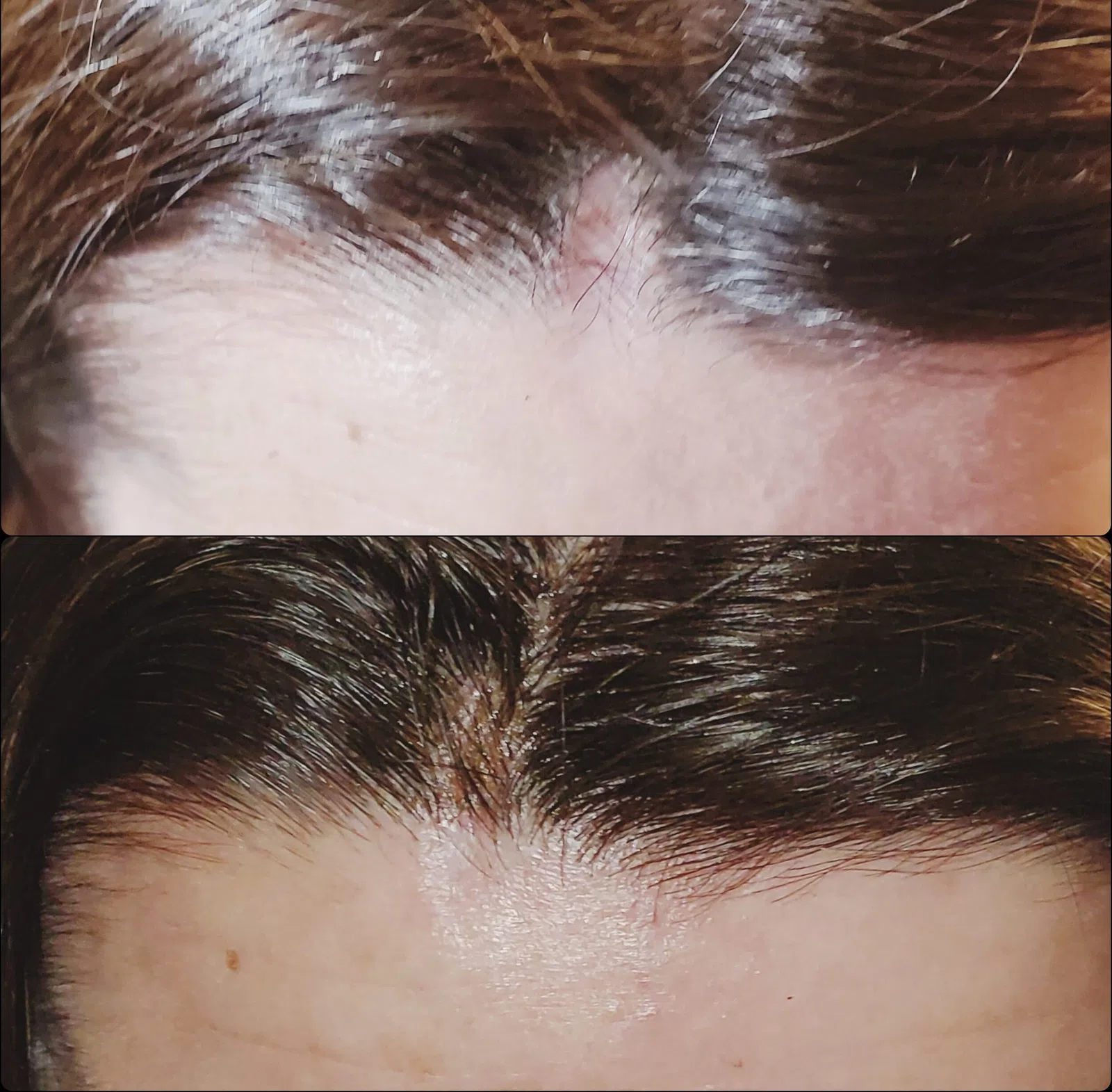 Scalp Micropigmentation result