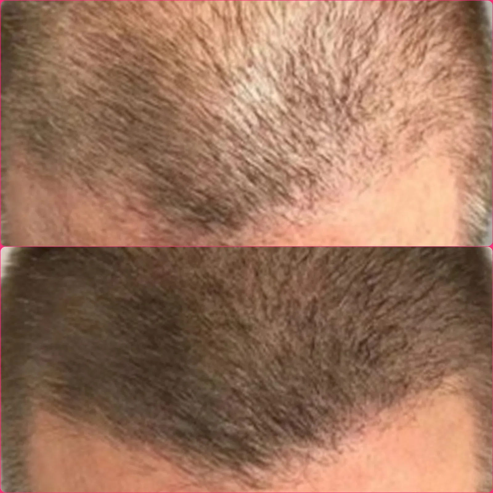 Scalp Micropigmentation result