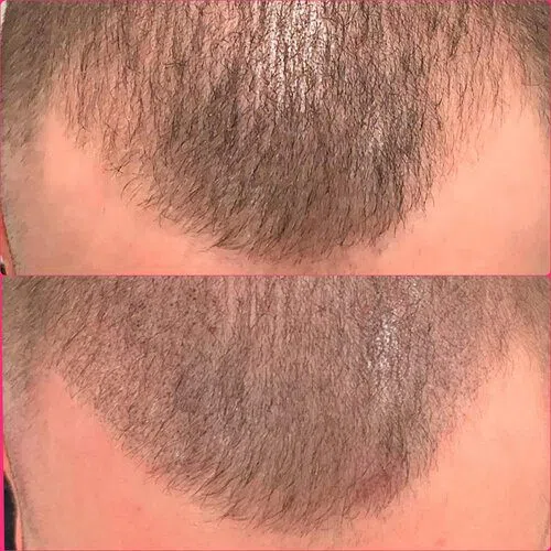 Scalp Micropigmentation result