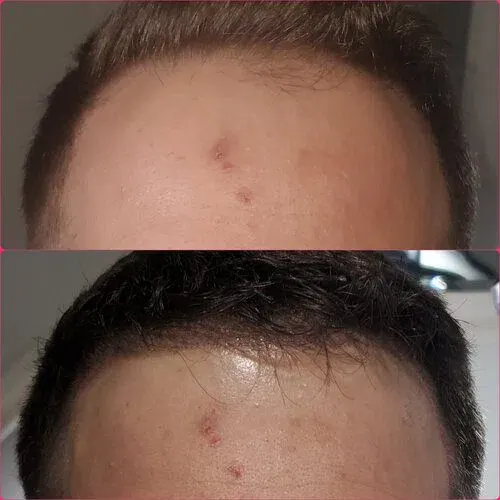 Scalp Micropigmentation result