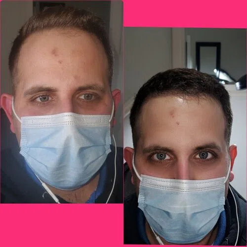 Scalp Micropigmentation result