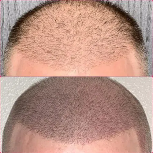 Scalp Micropigmentation result