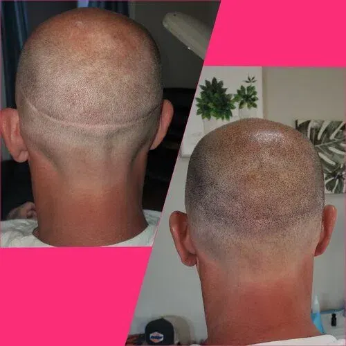 Scalp Micropigmentation result