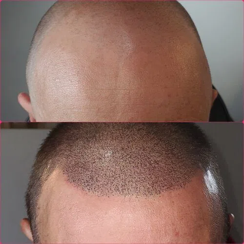 Scalp Micropigmentation result