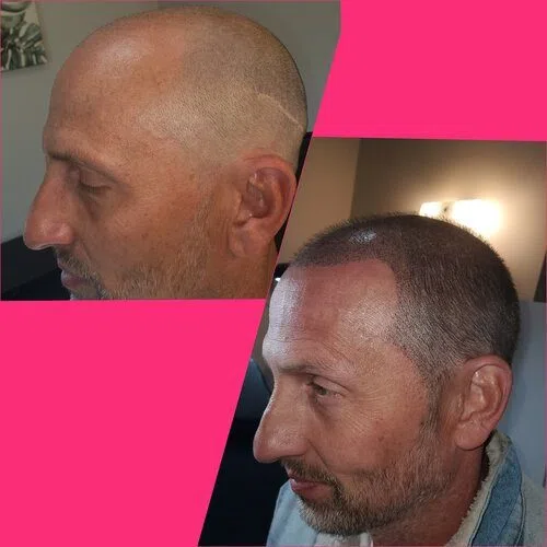 Scalp Micropigmentation result
