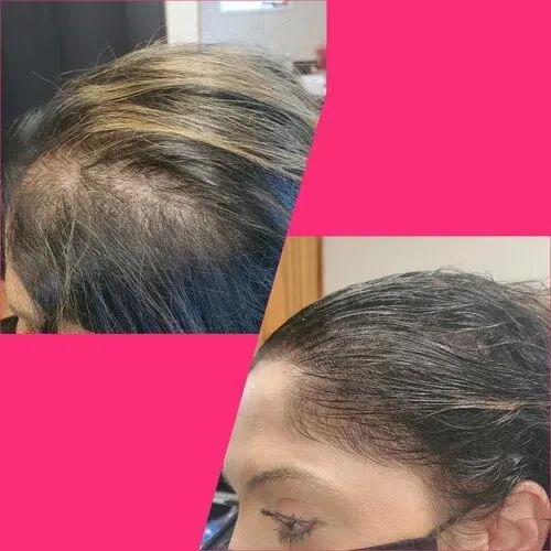 Scalp Micropigmentation result