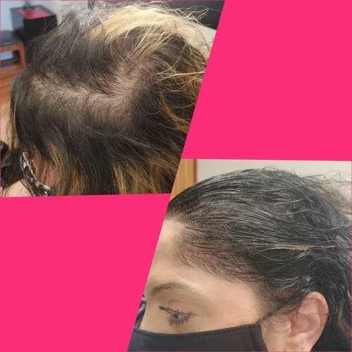 Scalp Micropigmentation result