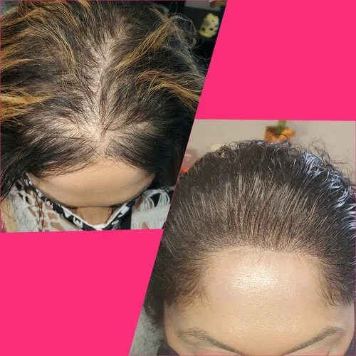 Scalp Micropigmentation result