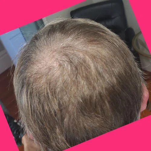 Scalp Micropigmentation result