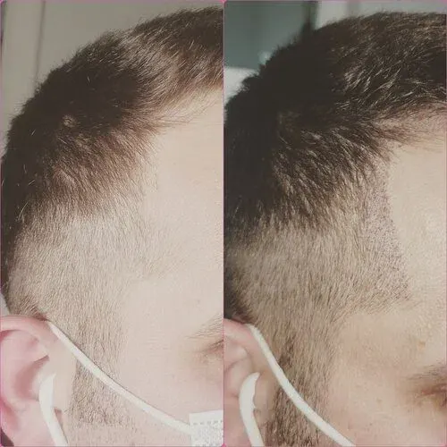 Scalp Micropigmentation result