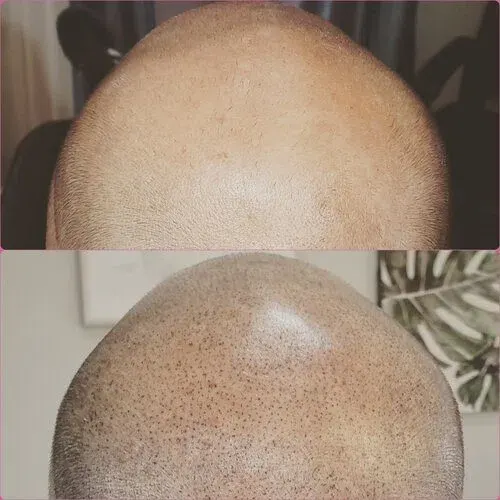 Scalp Micropigmentation result