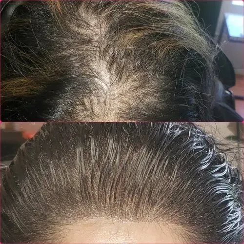 Scalp Micropigmentation result