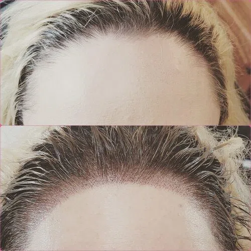Scalp Micropigmentation result