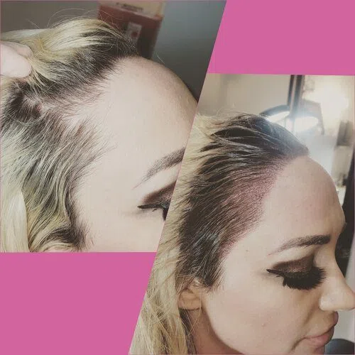 Scalp Micropigmentation result