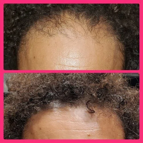 Scalp Micropigmentation result
