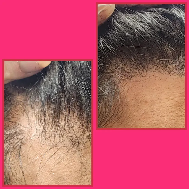 When to Consider Micropigmentation